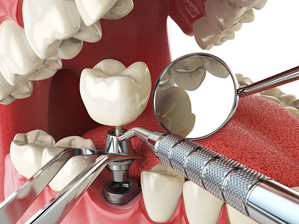 Best Chipped Tooth Repair Near Me  in Englewood, CO